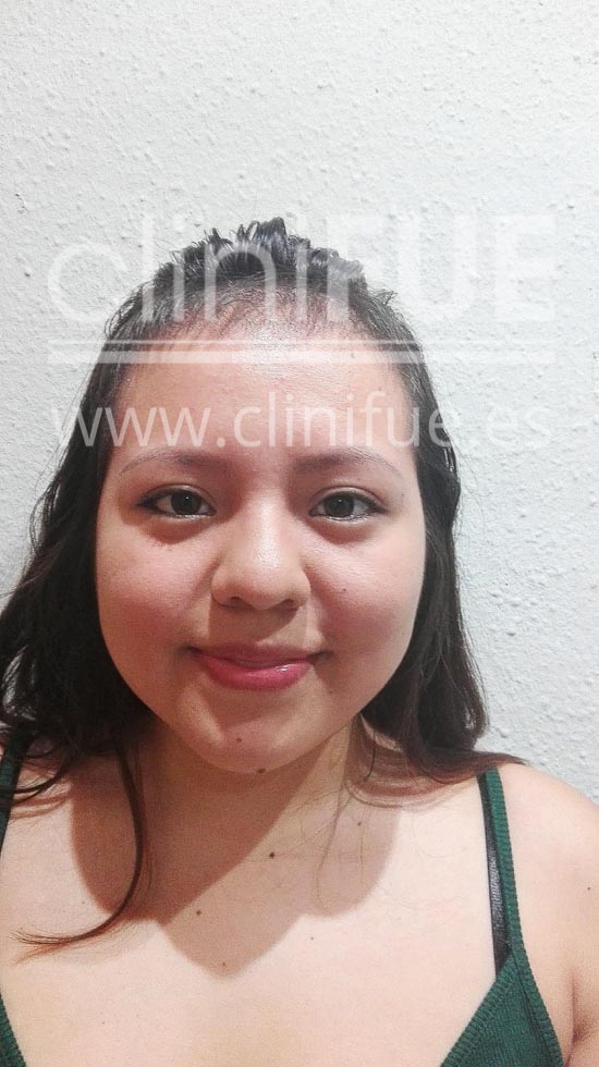 Diandra 22 Barcelona trasplante capilar femenino 3 meses