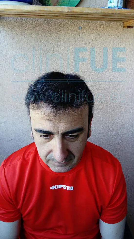 Jose Javier 47 Sevilla trasplante capilar 9 meses