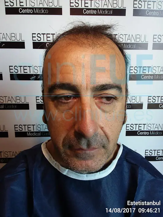 Jose Javier 47 años Sevilla trasplante capilar turquia Antes