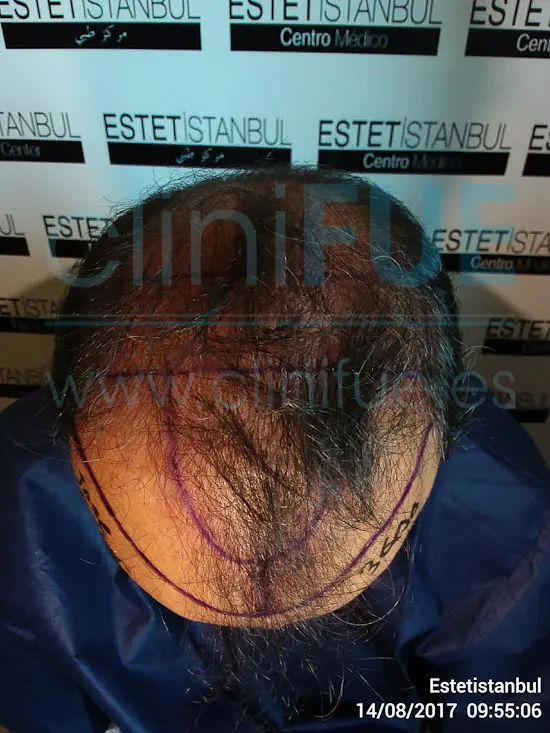 Jose Javier 47 Sevilla trasplante capilar Dia Operacion