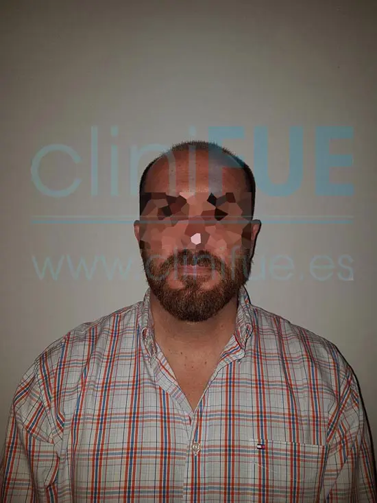 Juan Antonio 41 años Malaga injerto capilar estambul 3 meses