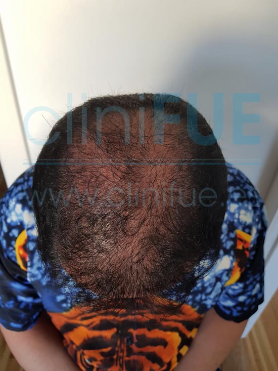 Luciano 44 años trasplante capilar turquia 10 meses