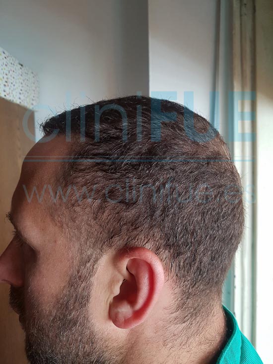 David 32 años Madrid injerto capilar turquia 9 meses