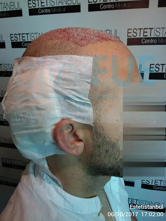 David 32 años Madrid injerto capilar turquia Dia Operacion