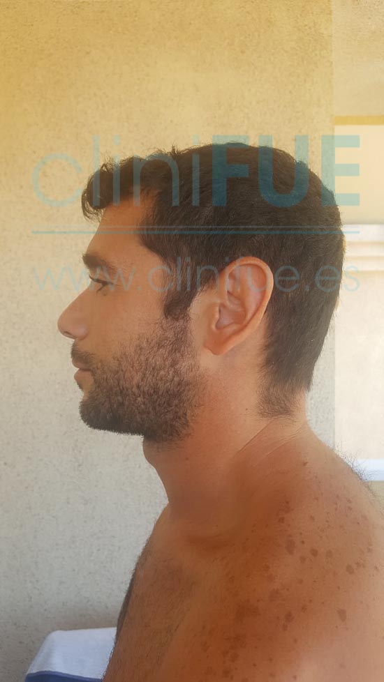 Jose 30 años Murcia trasplante capilar turquia 12 meses