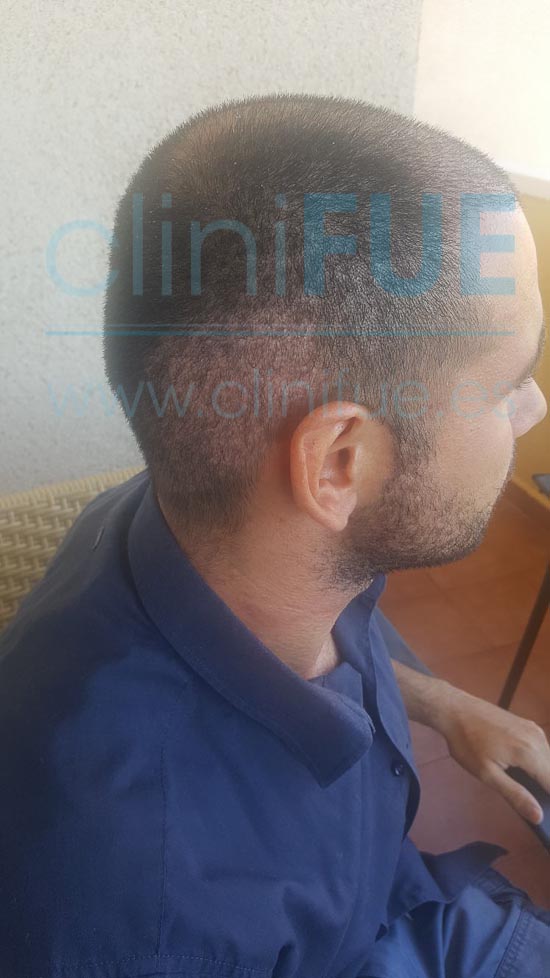 Jose 30 años Murcia trasplante capilar turquia 15 dias