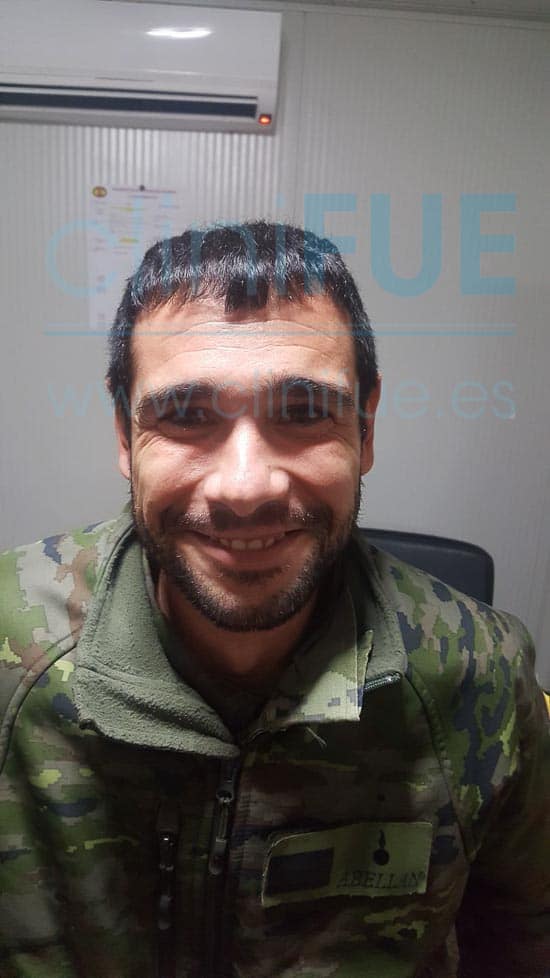 Jose 30 años Murcia trasplante capilar turquia 6 meses