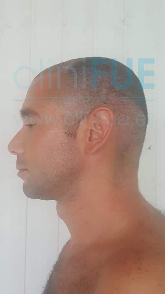 Jose 30 años Murcia trasplante capilar turquia 7 dias