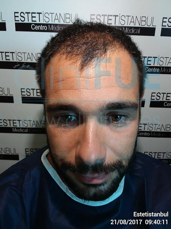 Jose 30 años Murcia trasplante capilar turquia Antes