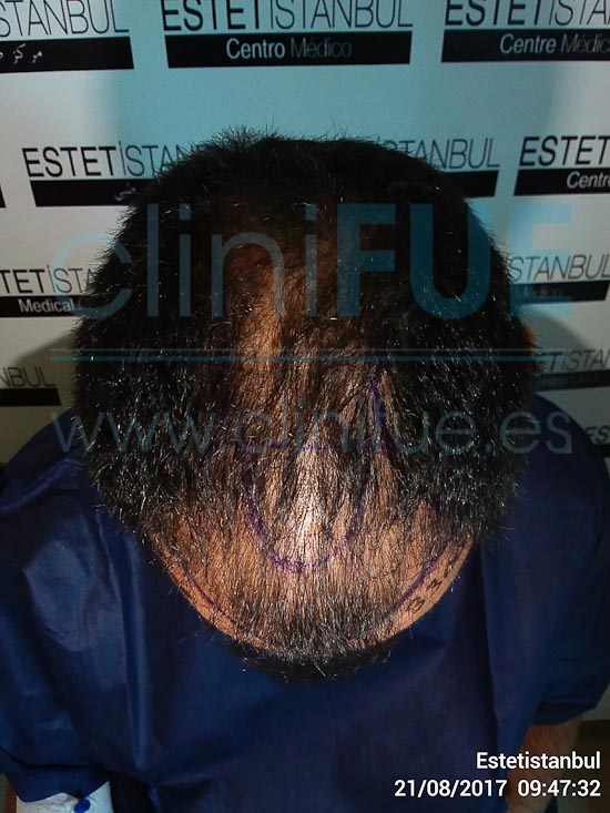 Jose 30 años Murcia trasplante capilar turquia Dia Operacion