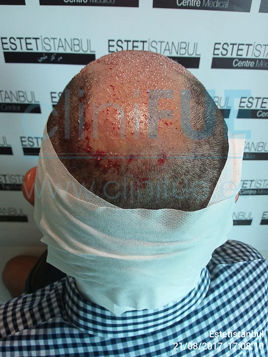Jose 30 años Murcia trasplante capilar turquia Dia Operacion