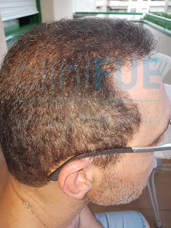 Juan Jose 45 Barcelona trasplante capilar turquia 12 meses