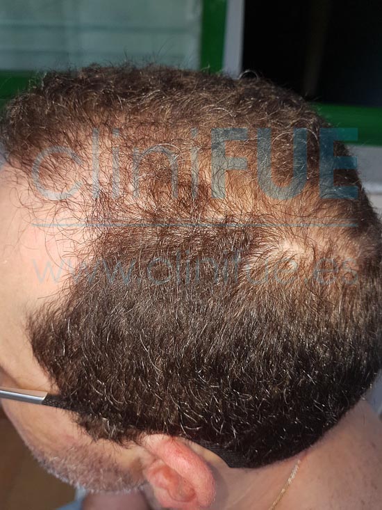 Juan Jose 45 Barcelona trasplante capilar turquia 12 meses