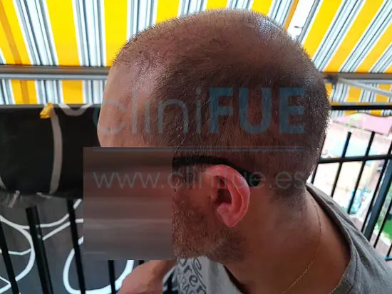 Juan Jose 45 Barcelona trasplante capilar turquia 15 días