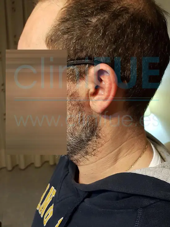 Juan Jose 45 Barcelona trasplante capilar turquia 3 meses