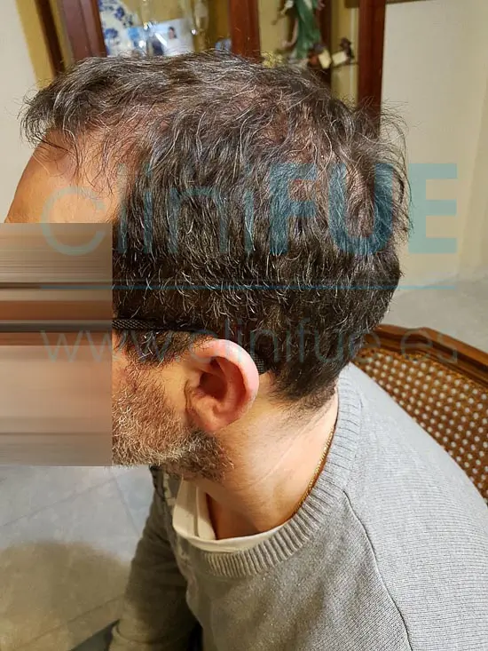 Juan Jose 45 Barcelona trasplante capilar turquia 6 meses