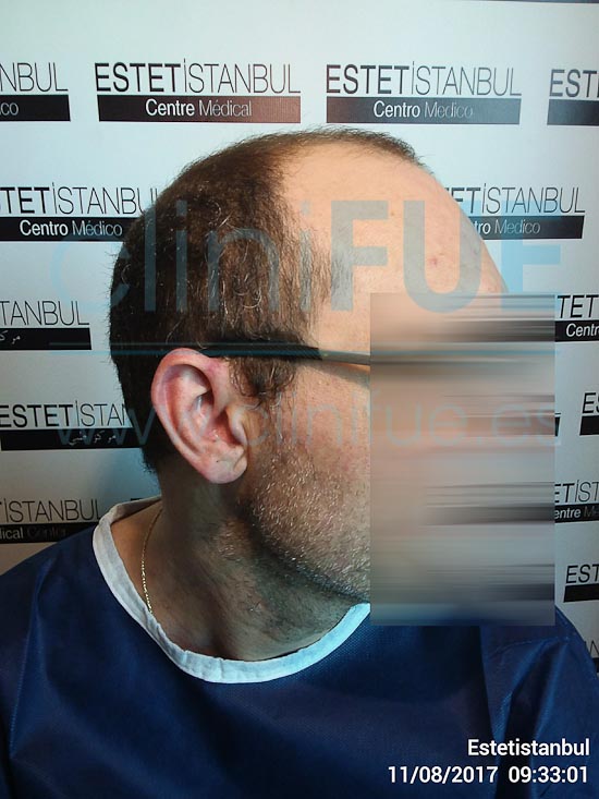 Juan Jose 45 Barcelona trasplante capilar turquia Antes