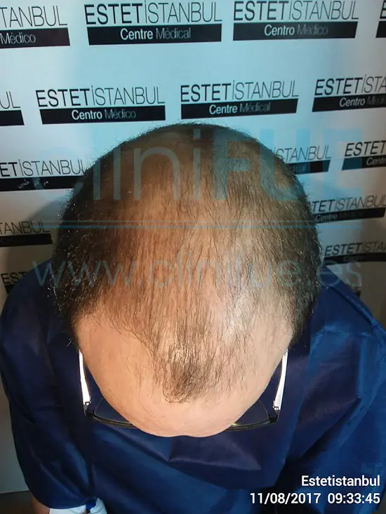 Juan Jose 45 Barcelona trasplante capilar turquia Antes
