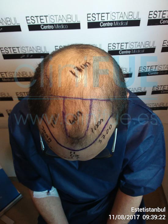 Juan Jose 45 Barcelona trasplante capilar turquia Dia Operacion