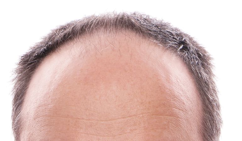 combatir la alopecia trasplante capilar