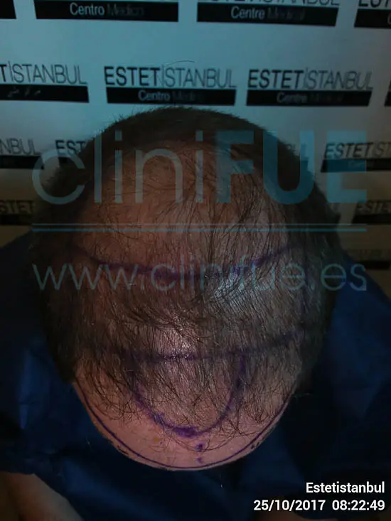 Emilio 38 Sevilla trasplante capilar cliniFUE Dia Operacion