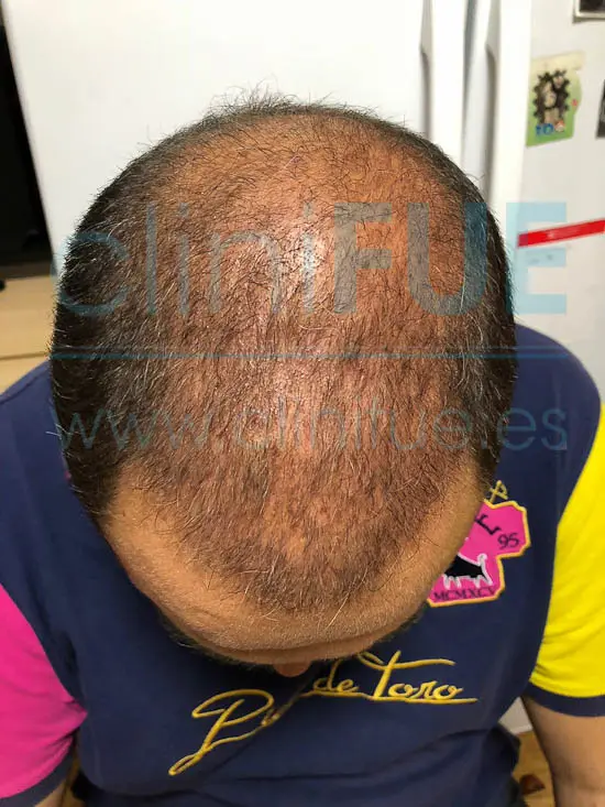 Juan José 45 Almeria injerto capilar turquia 3 meses