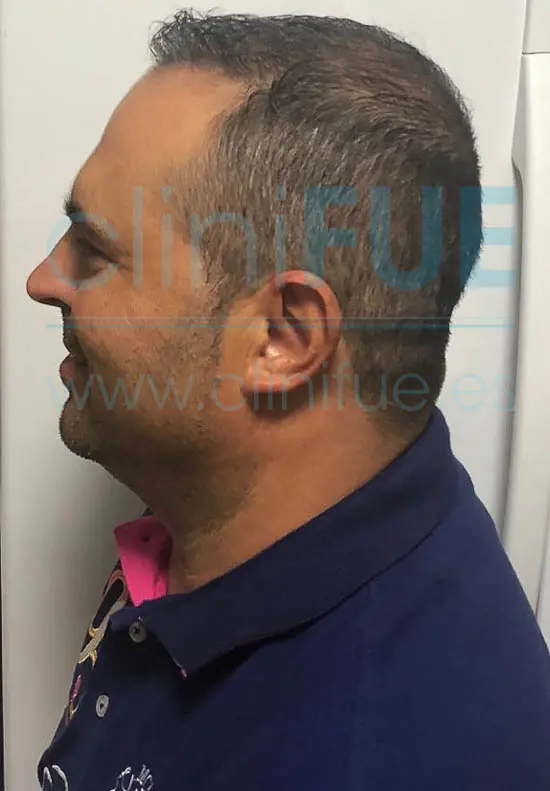 Juan José 45 Almeria injerto capilar turquia 6 meses