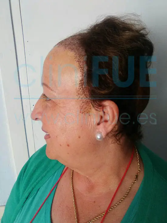 Felisa 63 años Cantabria trasplante capilar turquia 7 dias