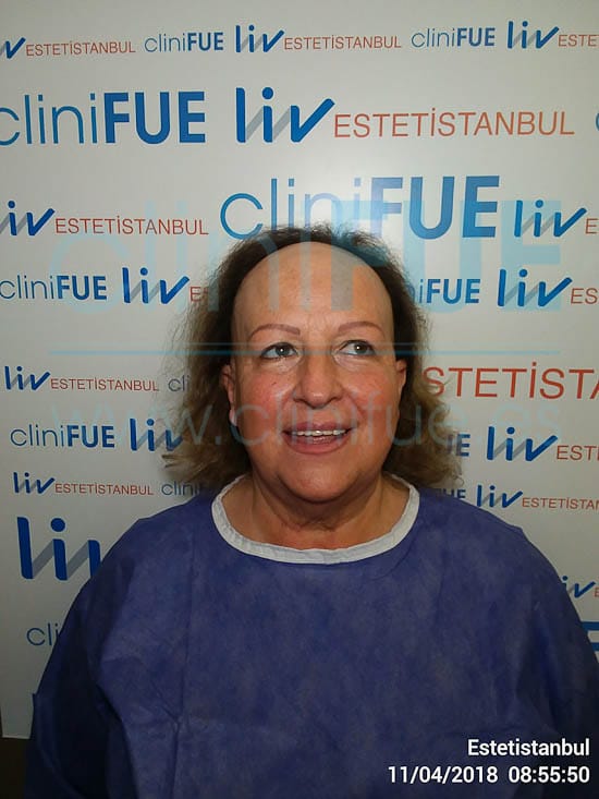 Felisa 63 años Cantabria trasplante capilar turquia Antes