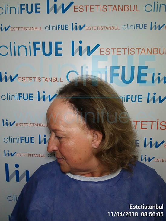 Felisa 63 años Cantabria trasplante capilar turquia Antes