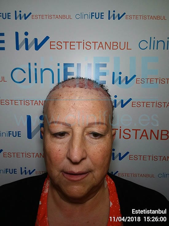 Felisa 63 años Cantabria trasplante capilar turquia Dia Operacion