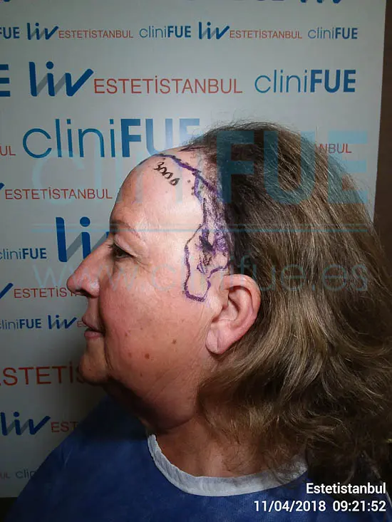 Felisa 63 años Cantabria trasplante capilar turquia Dia Operacion