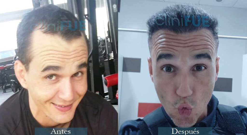 Fran 34 años Murcia trasplante capilar turquia 6 meses despues de la segunda operacion 