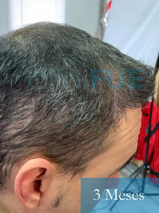 Fran 34 años Murcia trasplante capilar turquia 3 meses despues de la segunda operacion 