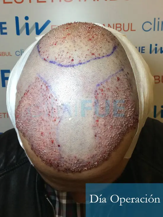 Fran 34 años Murcia trasplante capilar turquia dia de la segunda operacion 2