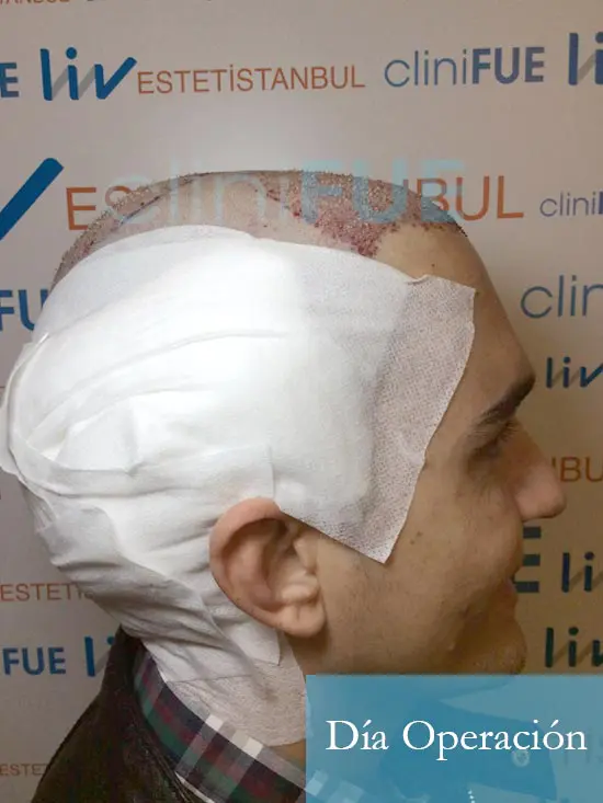 Fran 34 años Murcia trasplante capilar turquia dia de la segunda operacion 3