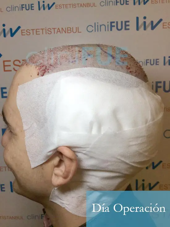 Fran 34 años Murcia trasplante capilar turquia dia de la segunda operacion 4