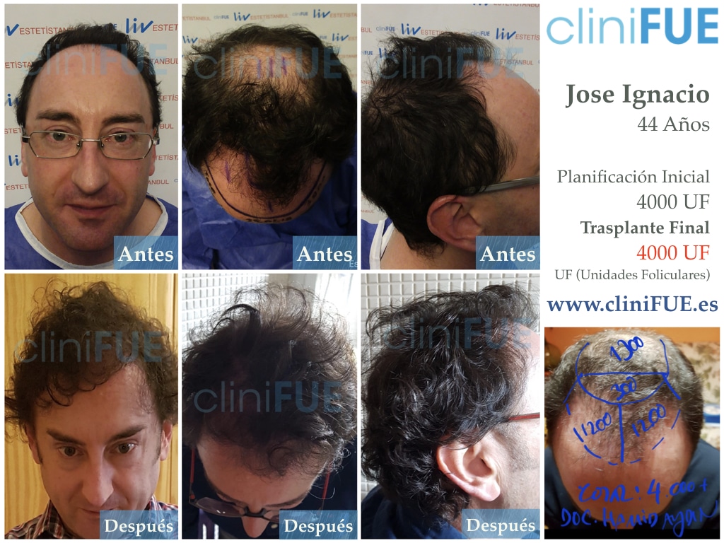 Jose-Ignacio-33-trasplante-pelo-12-meses 1