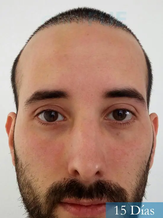 Jonathan 31 años Las Palmas trasplante capilar turquia 15 dias 