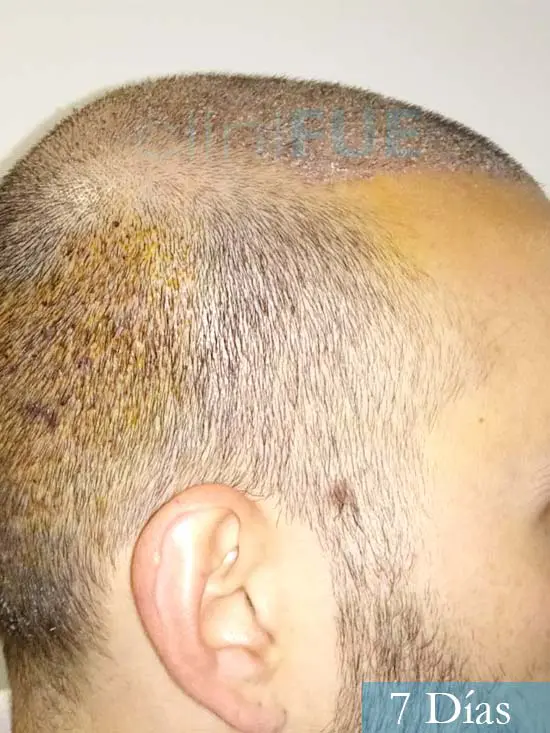 Jonathan 31 años Las Palmas trasplante capilar turquia 7 dias 4