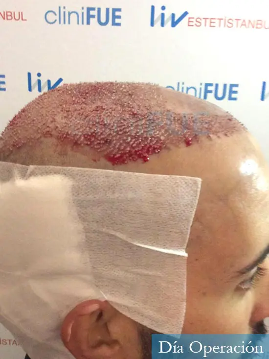 Jonathan 31 años Las Palmas trasplante capilar turquia dia operacion rapada 
