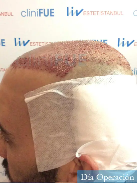 Jonathan 31 años Las Palmas trasplante capilar turquia dia operacion 4