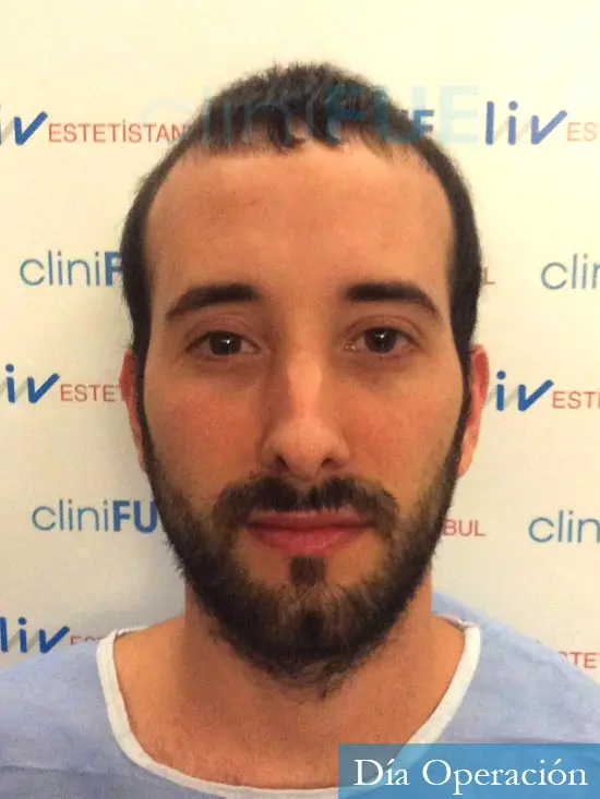 Jonathan 31 años Las Palmas trasplante capilar turquia antes dia operacion 