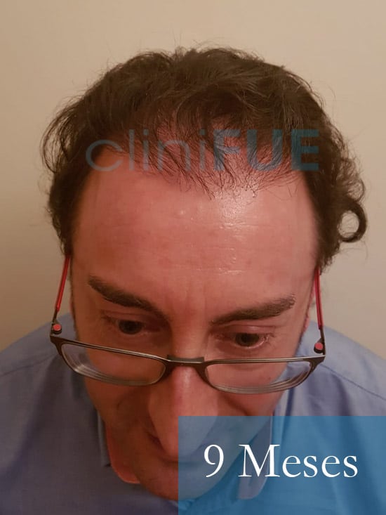Jose-Ignacio-33-trasplante-pelo-7-meses 2