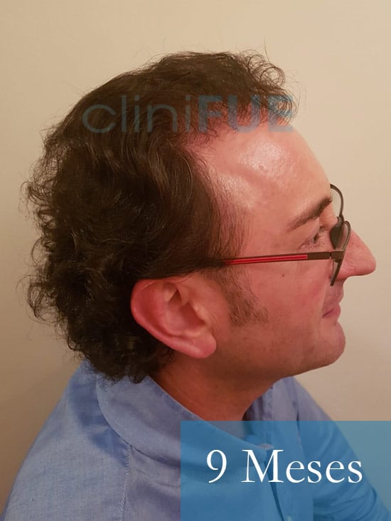Jose-Ignacio-33-trasplante-pelo-9-meses 4