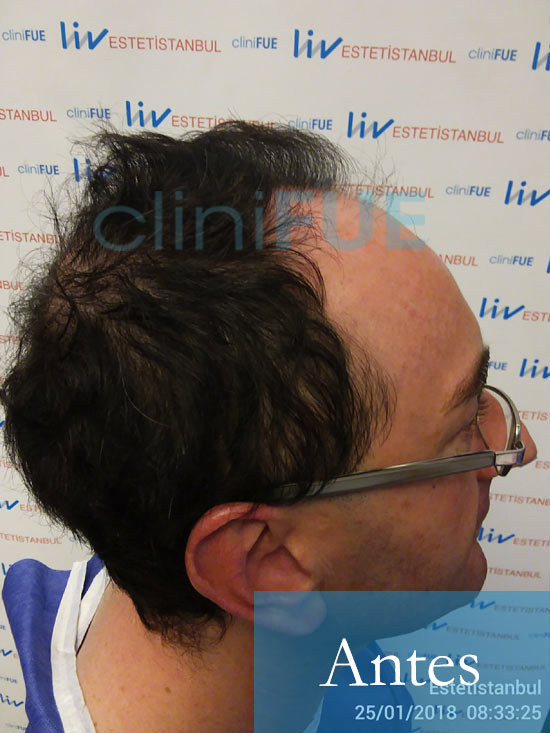 Jose-Ignacio-33-trasplante-pelo-antes-2