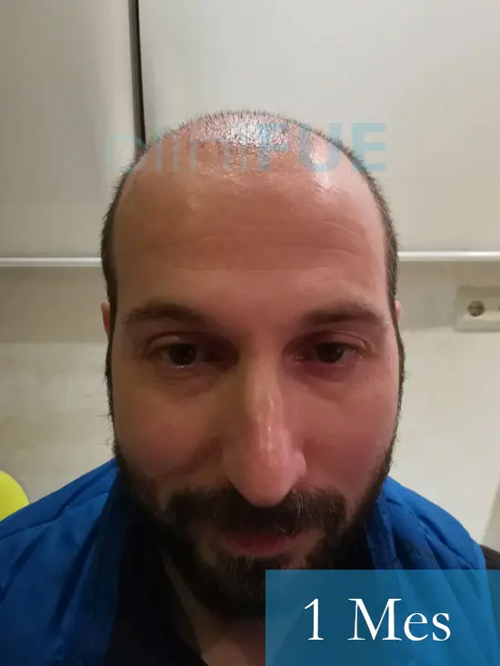 Juan Antonio 36 Mallorca trasplante turquia primera operacion 1 mes 