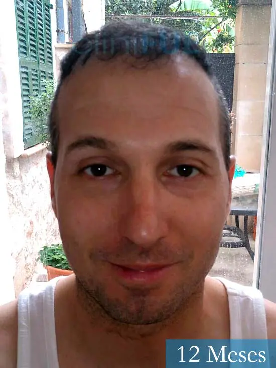 Juan Antonio 36 años Mallorca injerto capilar turquia segunda operacion antes 