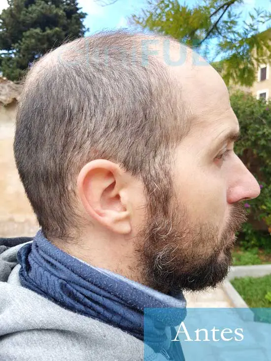 Juan Antonio 36 años Mallorca injerto capilar turquia primera operacion 4