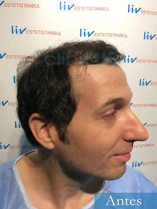Juan-Antonio-36-Mallorca-trasplante-turquia-segunda-operacion-dia operacion 3